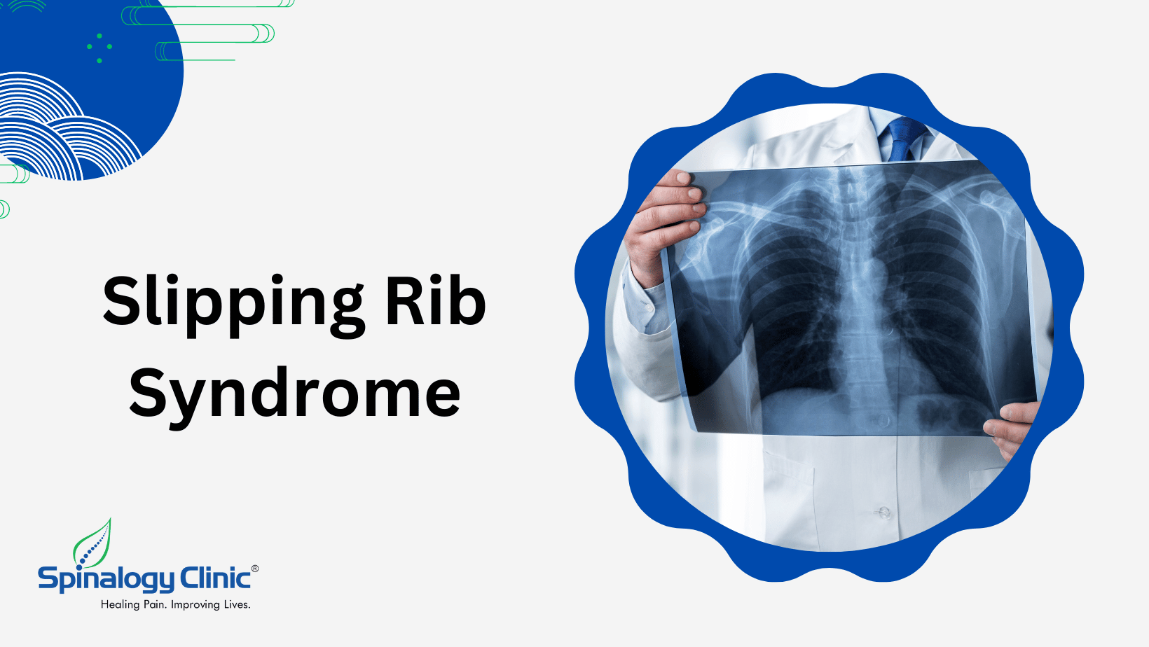 Slipping Rib Syndrome